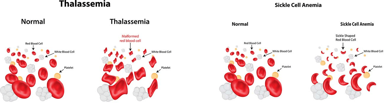 thalassemia and sickle cell anemia